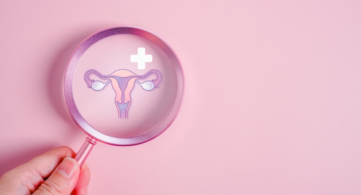 Imagen de un útero con ovarios poliquísticos