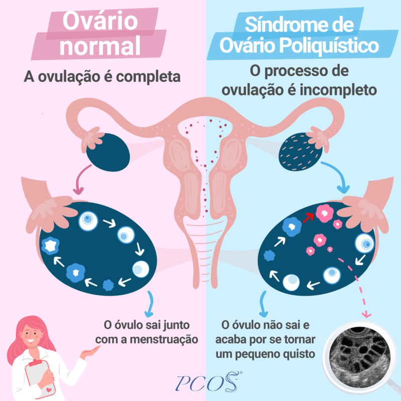 Imagem explicativa de como funciona a ovulação em um ovário normal e em outro com SOP