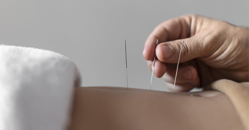 Mujer practicando acupuntura para controlar la ansiedad de su paciente.