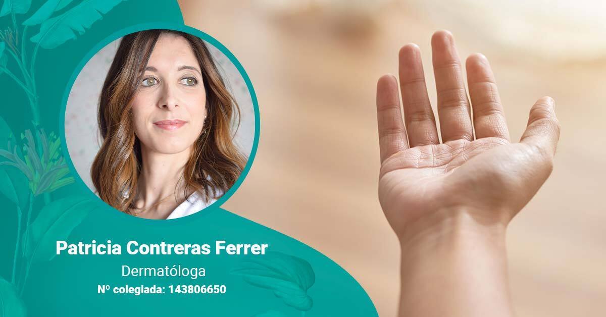 Psoriasis en las manos por la doctora Patricia Contreras Ferrer