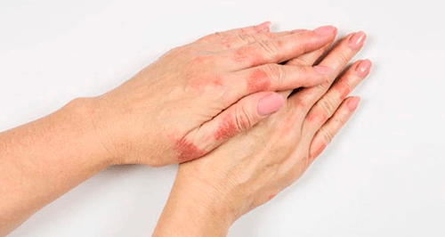 Dermatitis atópica en manos y diferencia psoriasis dermatitis