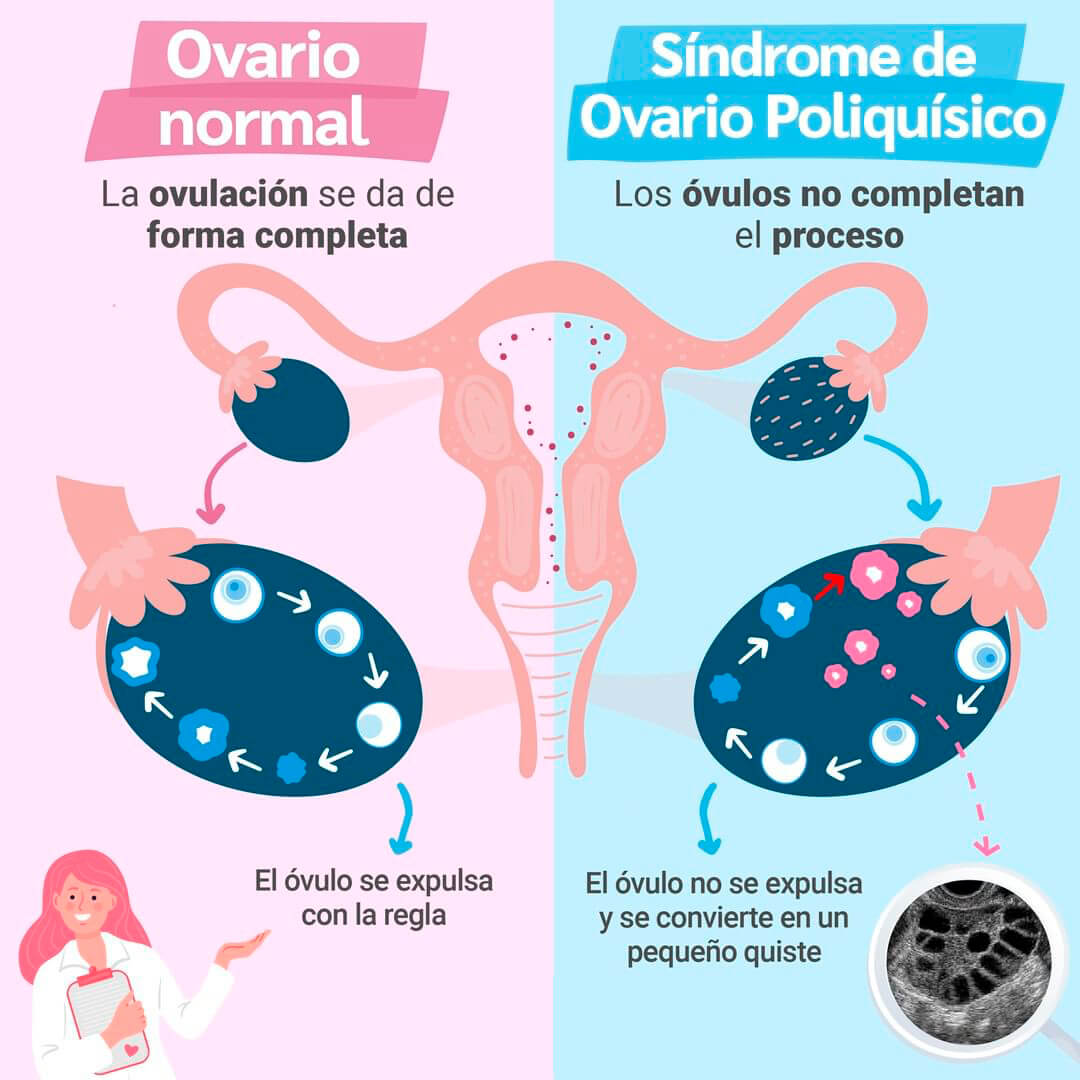 Infografía con las diferencias entre un ovario normal y el síndrome de ovario poliquístico