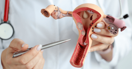 Doctora sosteniendo una maqueta de un ovario de tipo poliquístico