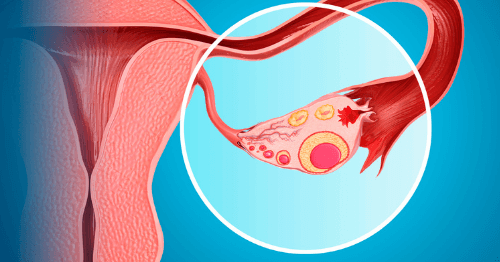 Infografía de un ovario con quistes