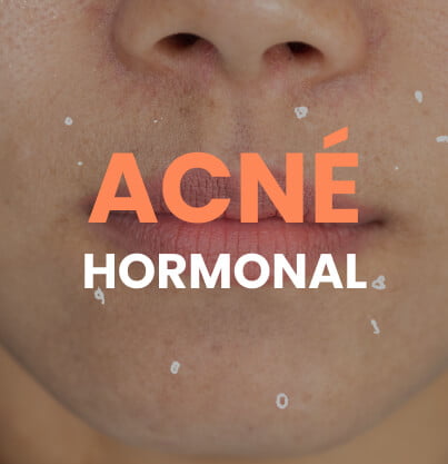 Portada artículo Acné hormonal y SOP