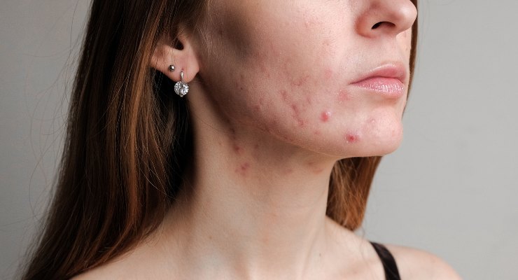 Mujer con acné, uno de los síntomas más habituales en los desequilibrios hormonales