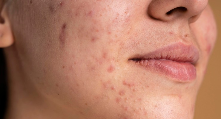 Mujer con rojeces e imperfecciones en la piel
