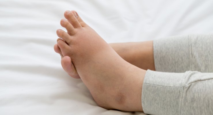 Mujer con retención de líquidos en pies y tobillos
